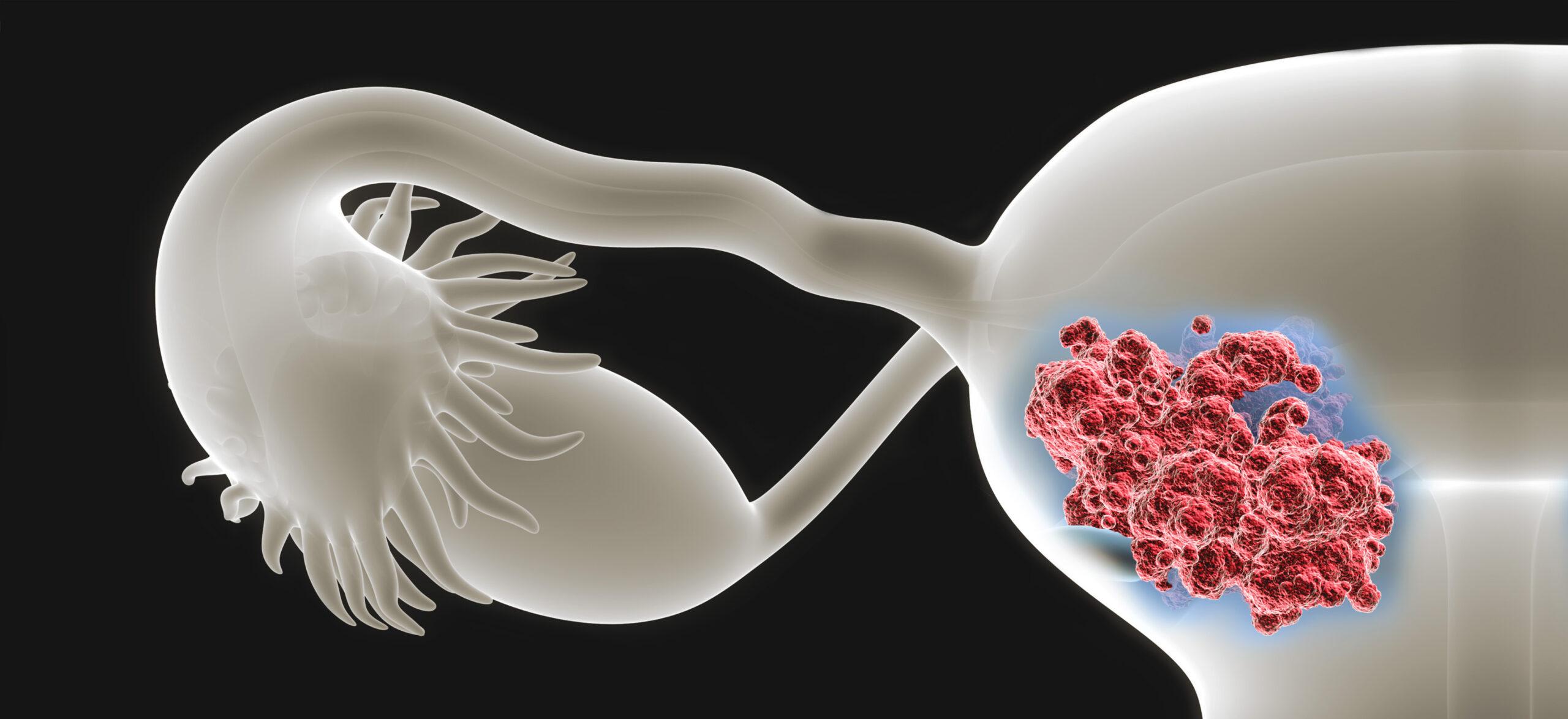 Perspective x-ray view of human uterus with endometrial cancer